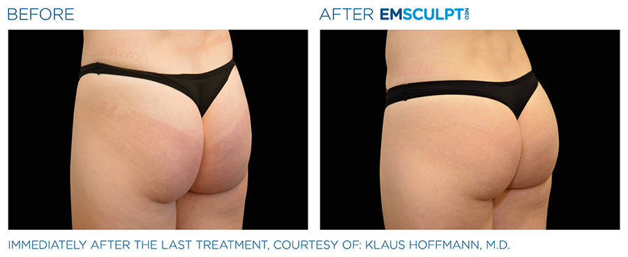 EMSCULPT NEO Before and After