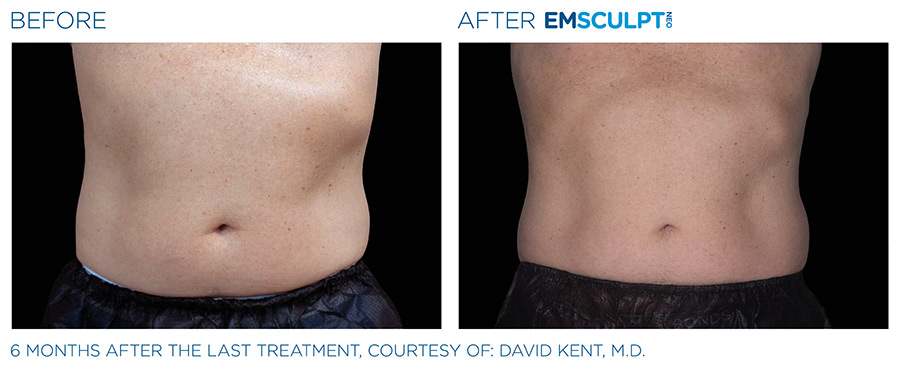 EMSCULPT NEO Before and After