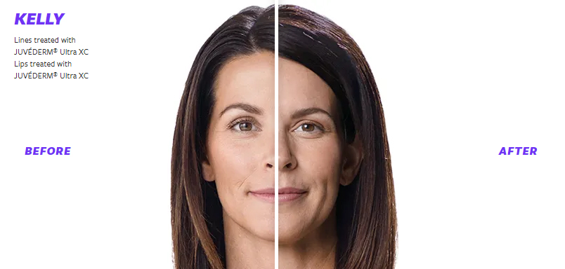 JUVÉDERM Before and After