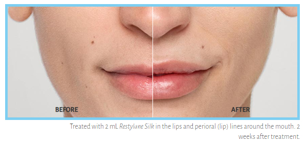 Restylane Silk Before and After