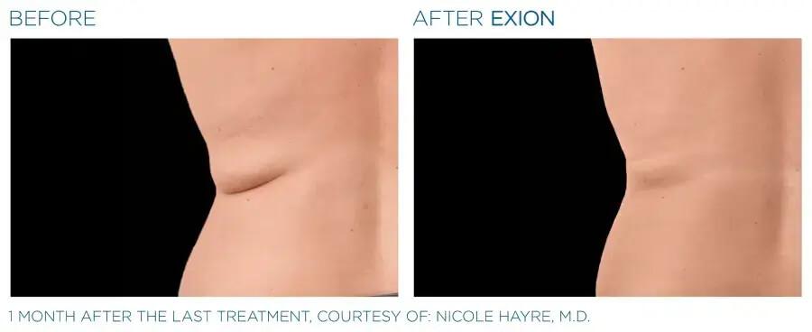Exion-Body-Before-and-after-2-1