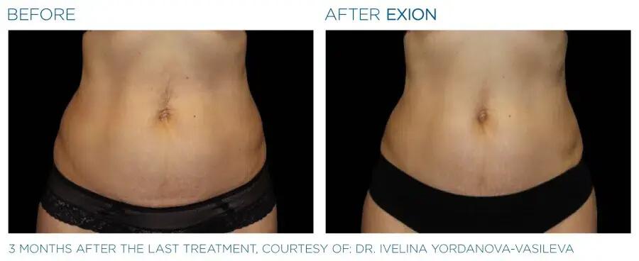 Exion-Body-Before-and-after-3-1