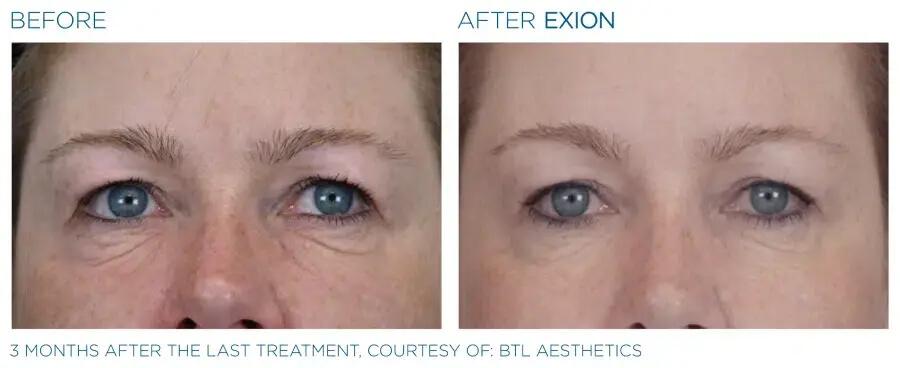 Exion Face Before and after 2 1