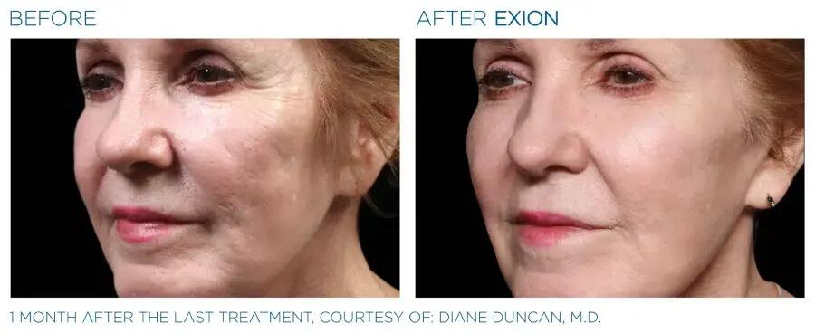 Exion Face Before and after 3 1