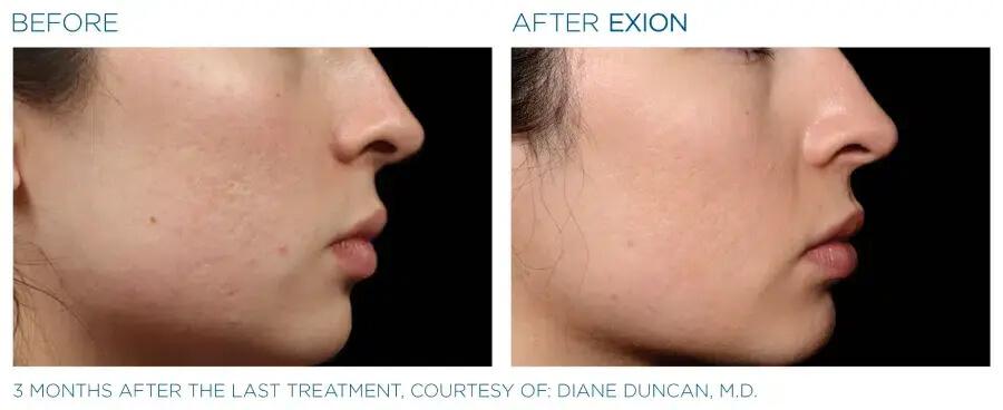 Exion RF Before and after 1