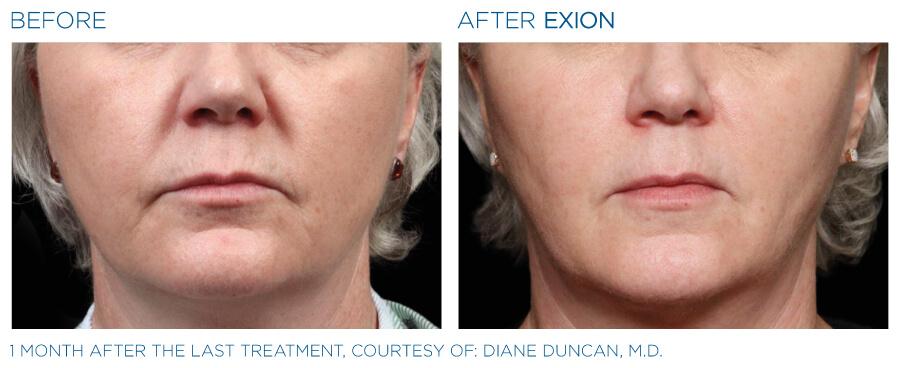 Exion RF Before and after 2
