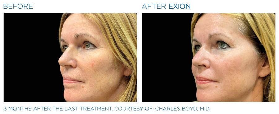 Exion RF Before and after 3